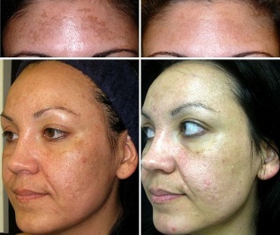 Before and after laser rejuvenation of non-ablative fractions