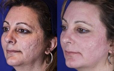 fractional laser rejuvenation before and after pictures